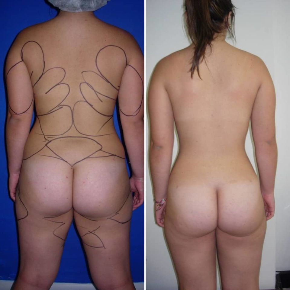 Dr. Jairo Zalamea Silva - Cirugía Plástica