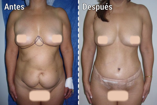 lipoescultura-liposuccion