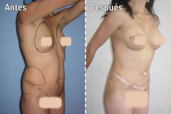 lipoescultura-liposuccion