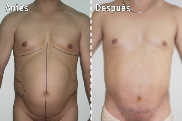 lipoescultura-liposuccion