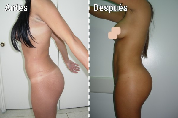 lipoinyeccion-glutea