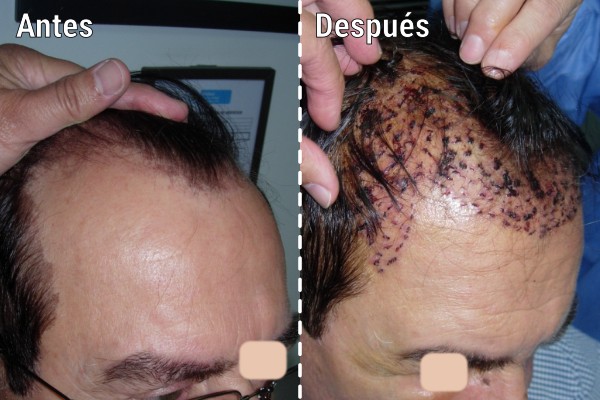 implantes-capilares