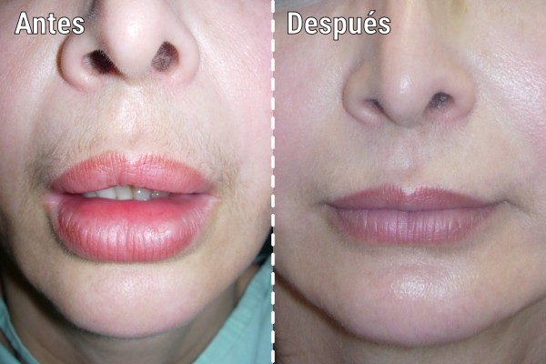 tratamiento-quirurgico-por-biopolimeros