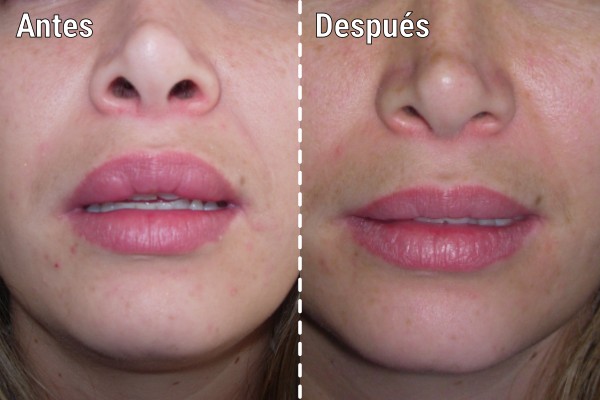 tratamiento-quirurgico-por-biopolimeros